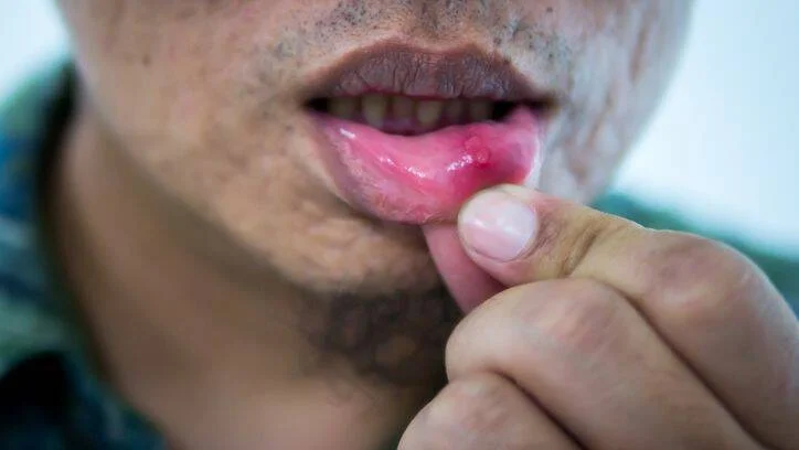 Persona jala su labio inferior para mostrar una úlcera o llaga bucal rojiza en la mucosa.