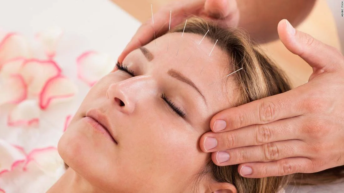 Terapeuta aplica agujas de acupuntura en la frente y sien de una mujer con los ojos cerrados.