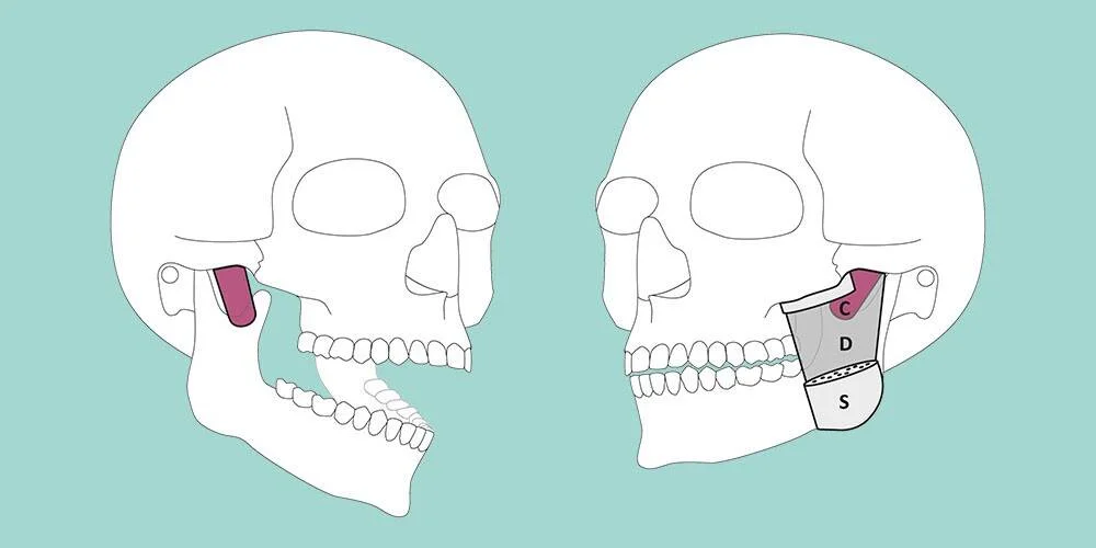 Ilustración médica comparativa de dos cráneos: uno con mandíbula retraída y otro con implante de mentón dividido en zonas C, D y S.