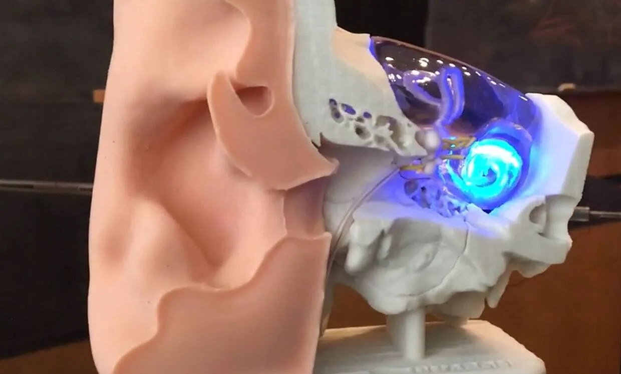 Modelo en 3D del oído humano con sección transversal que muestra un implante coclear con luz azul en su interior.