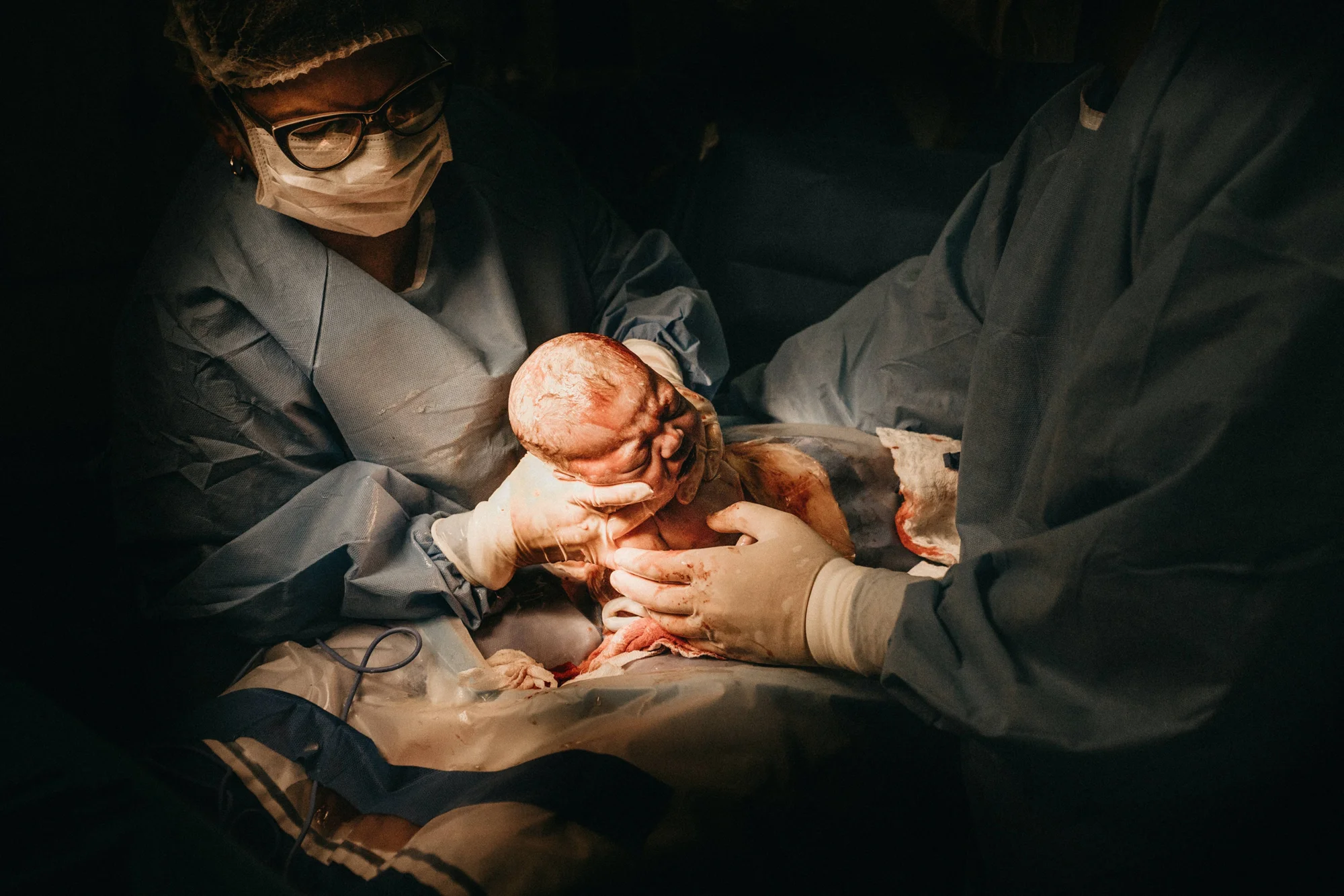 Personal médico con bata quirúrgica y guantes extrae a un recién nacido durante una cesárea.