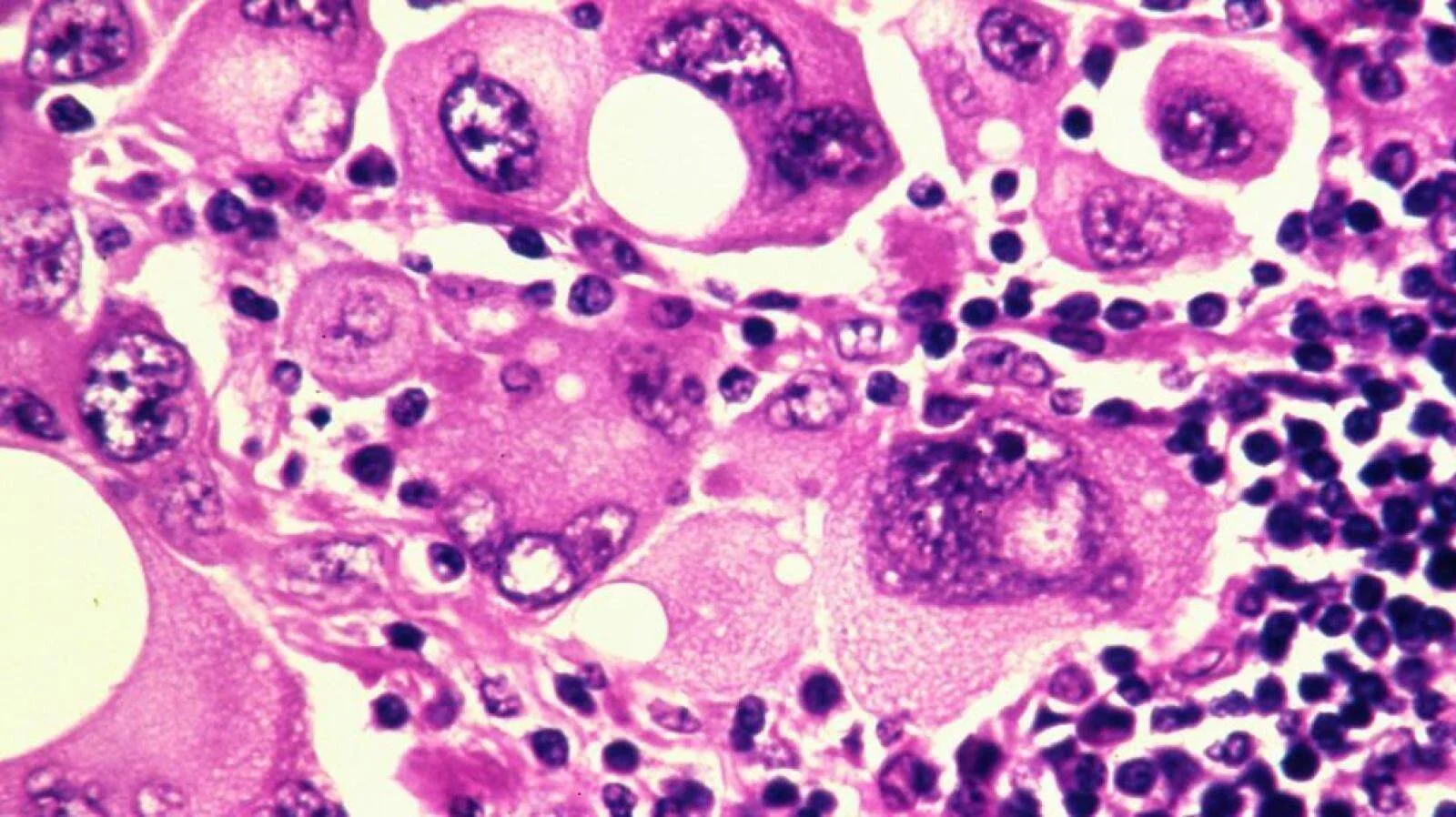 Muestra histológica teñida con hematoxilina y eosina que muestra células tumorales grandes con núcleos irregulares rodeadas de células pequeñas.