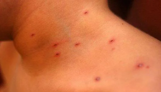 Piel del cuello con múltiples pequeñas manchas rojizas o picaduras distribuidas en la zona.