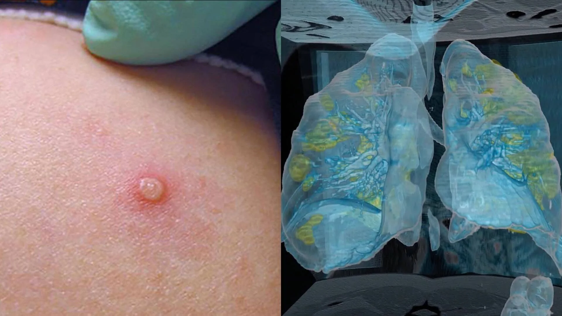 Pústula rojiza en la piel junto a una imagen de tomografía computarizada 3D que muestra pulmones con zonas comprometidas en amarillo y azul.