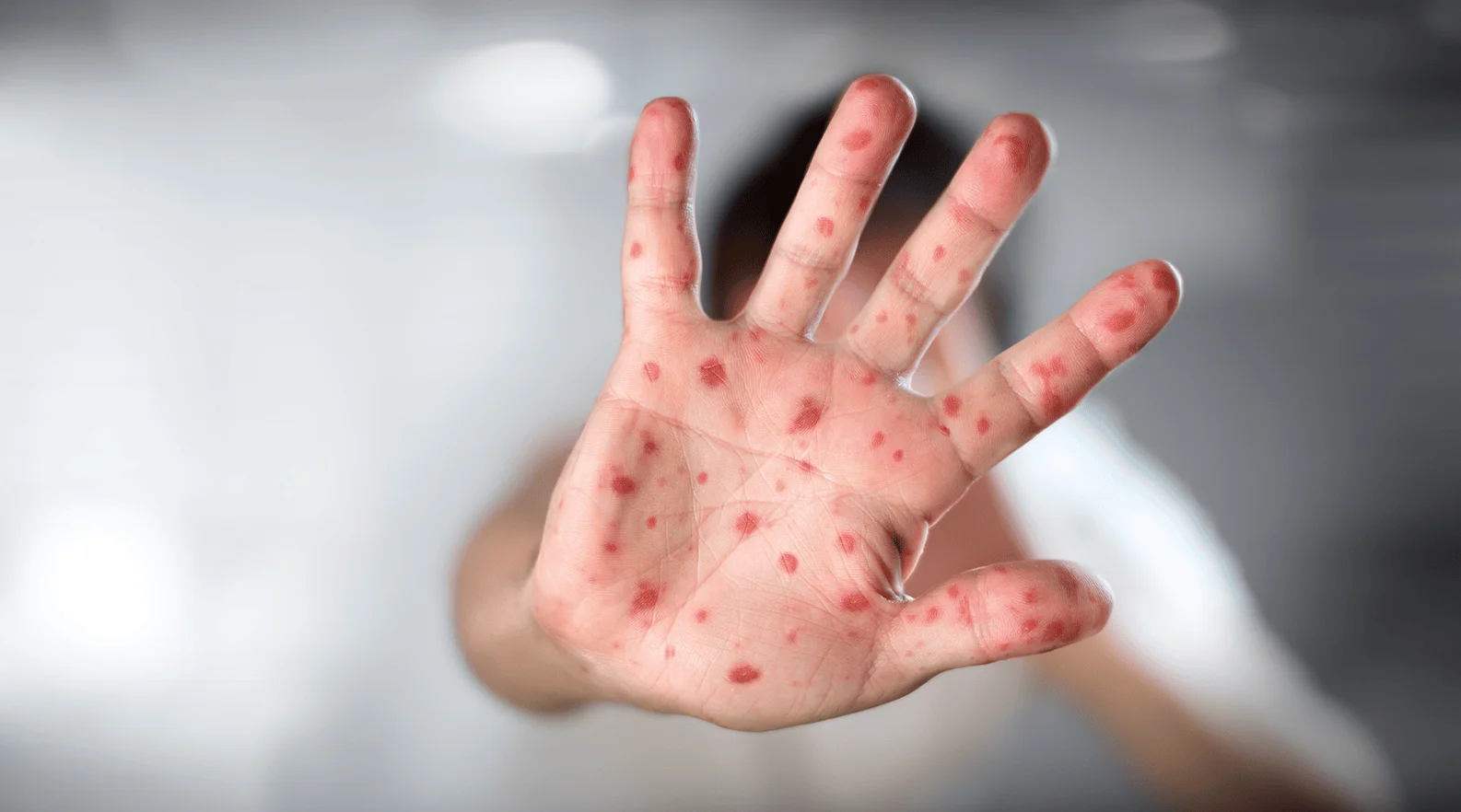 Palma de una mano con múltiples manchas y lesiones rojas características de una erupción cutánea infecciosa.