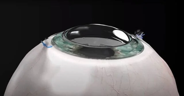 Ilustración médica 3D de un trasplante de córnea con suturas visibles sobre un globo ocular.