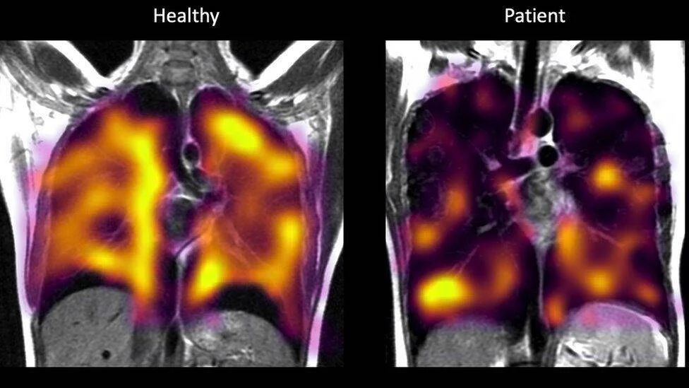 Escáneres pulmonares en color que comparan un pulmón sano con ventilación uniforme frente a uno enfermo con zonas oscuras que indican daño o falta de ventilación.
