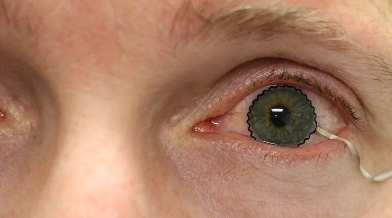 Primer plano de un ojo con iris verde y lente de contacto marcada con contorno digital dentado, con signos de irritación ocular.